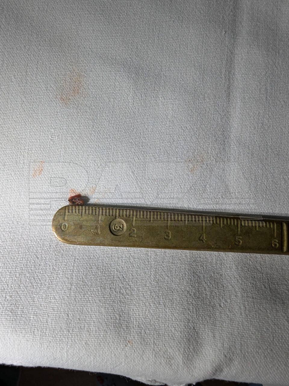 Россиянин год проходил с осколком снайперской пули в глазу